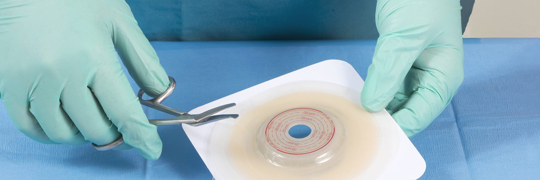 Ileostomy